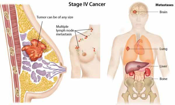 Hình ảnh các tế bào ung thư vú phát triển, lan rộng ở giai đoạn cuối.