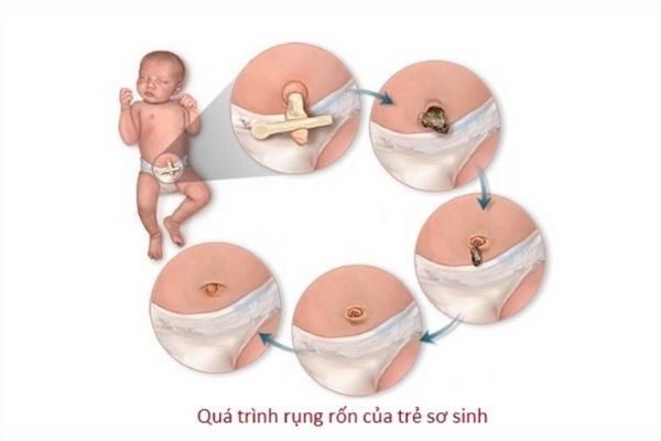 Quá trình rụng rốn của trẻ sơ sinh