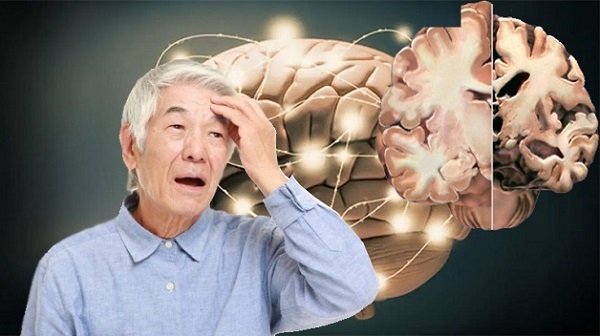 Alzheimer là nguyên nhân phổ biến gây chứng giảm trí nhớ ở người già