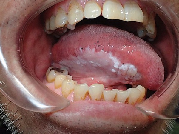 Bệnh bạch sản gây lở loát niêm mạc miệng, lưỡi