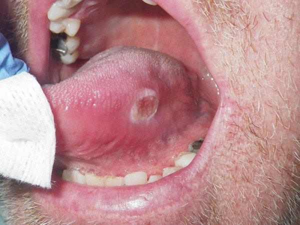 Triệu chứng đặc trưng của bệnh bạch sản là các vết loét trong miệng