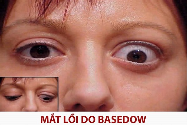 Bệnh basedow khiến mắt lồi hoặc nhìn đôi do bị liệt cơ vận nhãn