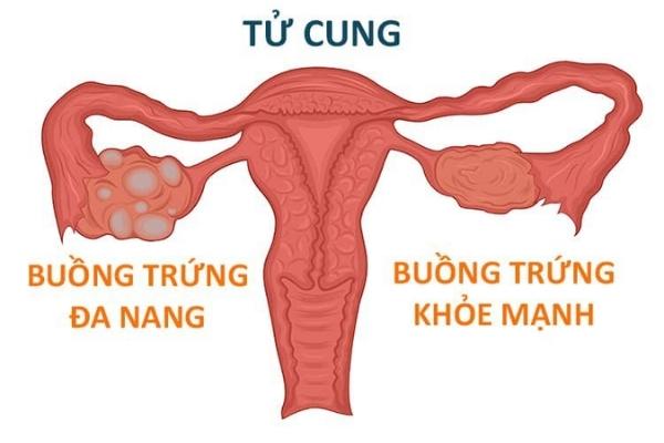 Đa nang buồng trứng là hội chứng thường gặp ở nữ giới