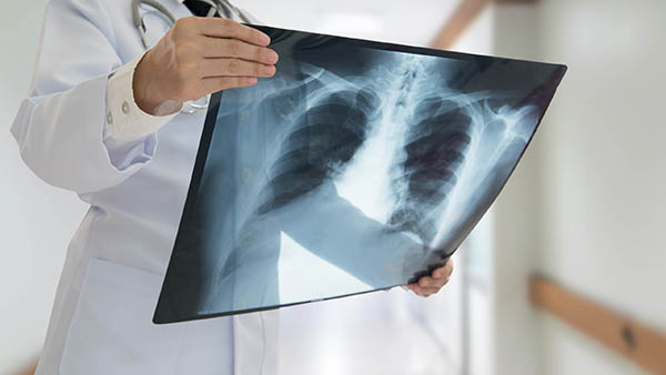 Chụp X-quang là một trong những phương pháp chẩn đoán lao phổi