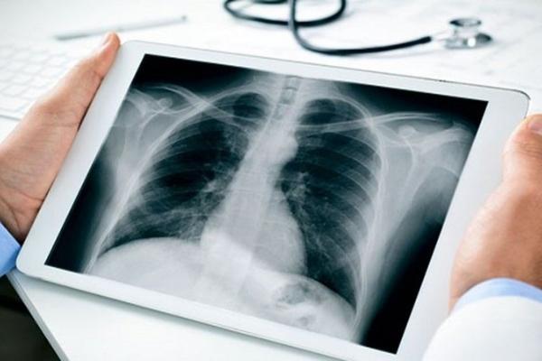 Hình ảnh X quang viêm phế quản phổi