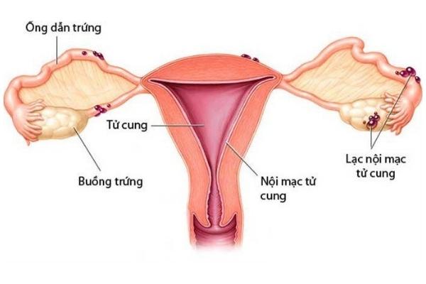 Lạc nội mạc tử cung là bệnh lý thường gặp ở phụ nữ