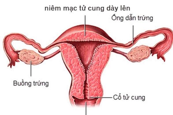 Niêm mạc tử cung dày hay mỏng đều khó mang thai