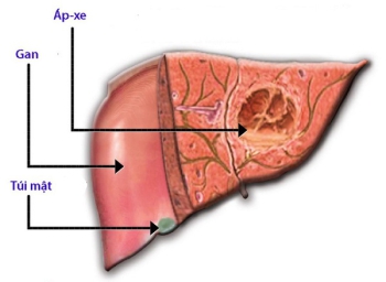 Áp xe gan do amip: Nguyên nhân, triệu chứng, chẩn đoán và điều trị