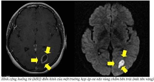 Áp xe não: Nguyên nhân, dấu hiệu nhận biết và phương pháp chữa trị