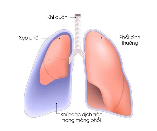 Hình ảnh minh họa tràn dịch màng phổi / tràn khí màng phổi