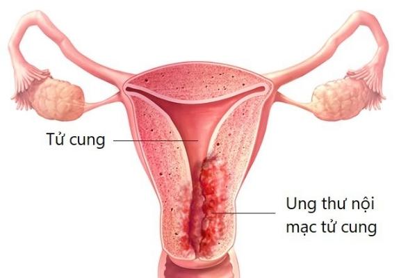 Ung thư nội mạc tử cung là nỗi lo sợ của phụ nữ