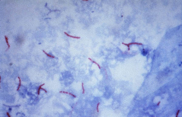 Vi khuẩn lao Mycobacterium tuberculosis nhuộm bằng phương pháp Ziehl–Neelsen