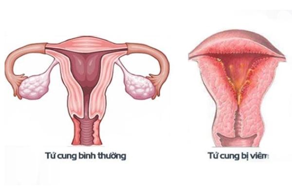 Viêm nội mạc tử cung có thể gây vô sinh