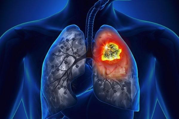 Biến chứng của viêm phế quản phổi có thể là ung thư phổi