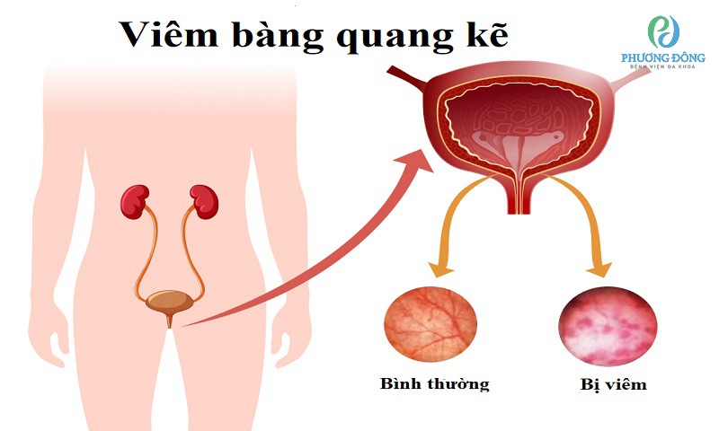 Viêm bàng quang kẽ có nguyên nhân gì?
