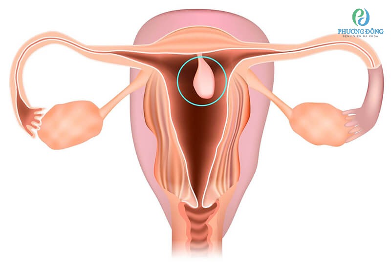 Polyp cổ tử cung cũng gây nên hiện tượng ra dịch nâu khi mang thai