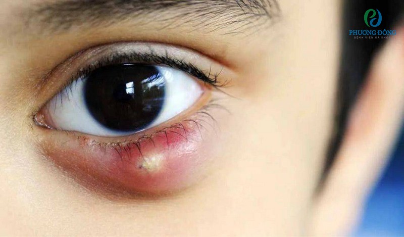 Mí mắt nổi mụn nước có nguy hiểm hay không? Hướng xử lý tốt nhất