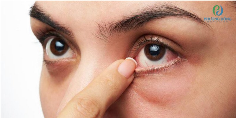 Do tuyến bã nhờn vùng mắt hoạt động quá mức dẫn đến nổi mụn
