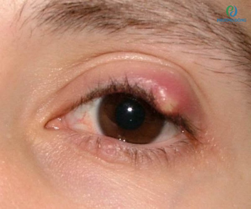 Mụn tại vùng mắt có thể xuất hiện sau 5-7 ngày và tự khỏi