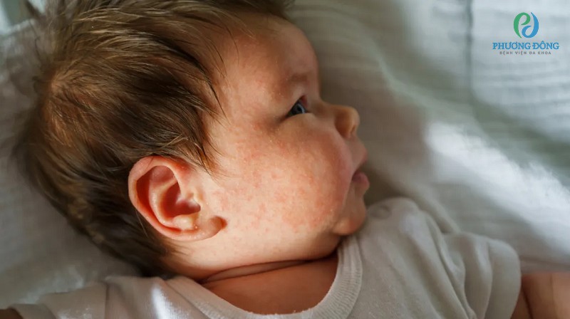 Trẻ từng mắc viêm da dị ứng có nguy cơ cao bị dị ứng đạm sữa bò