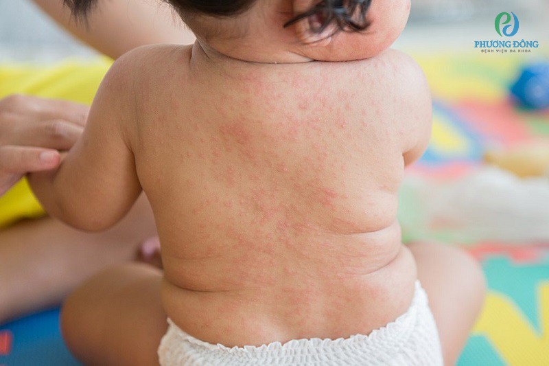 Trẻ bị sốt phát ban do nhiễm virus human herpes 6