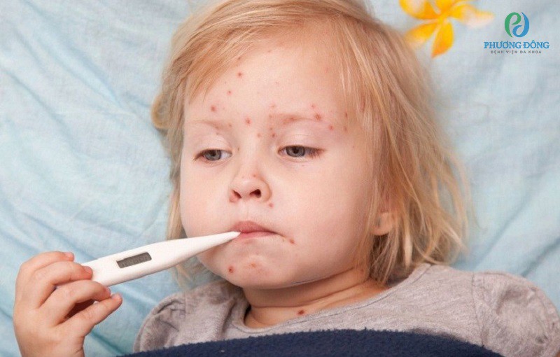 Trẻ bị sốt phát ban sẽ có dấu hiệu sốt cao và nổi ban đỏ nhưng không ngứa