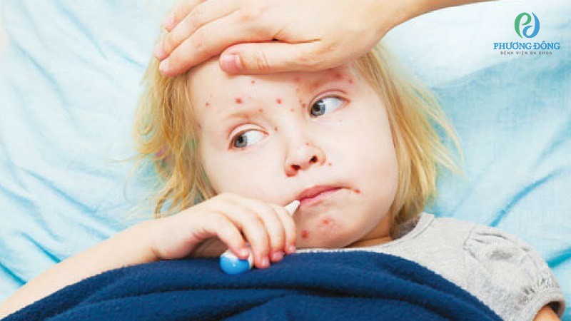 Trẻ bị sốt do nhiễm virus sởi