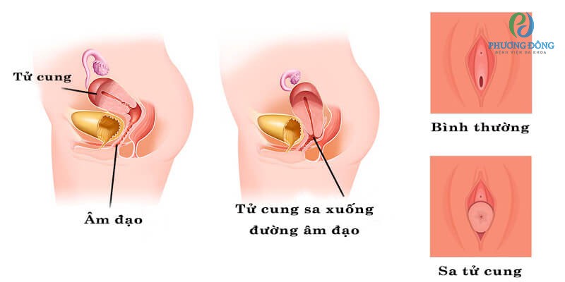 Hình ảnh tử cung sa xuống đường âm đạo khi bị sa tử cung