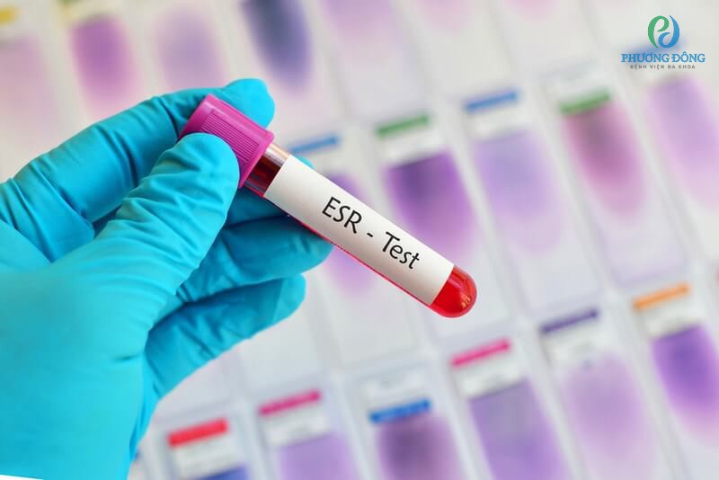 xét nghiệm ERS để chuẩn đoán bệnh lupus ban đỏ