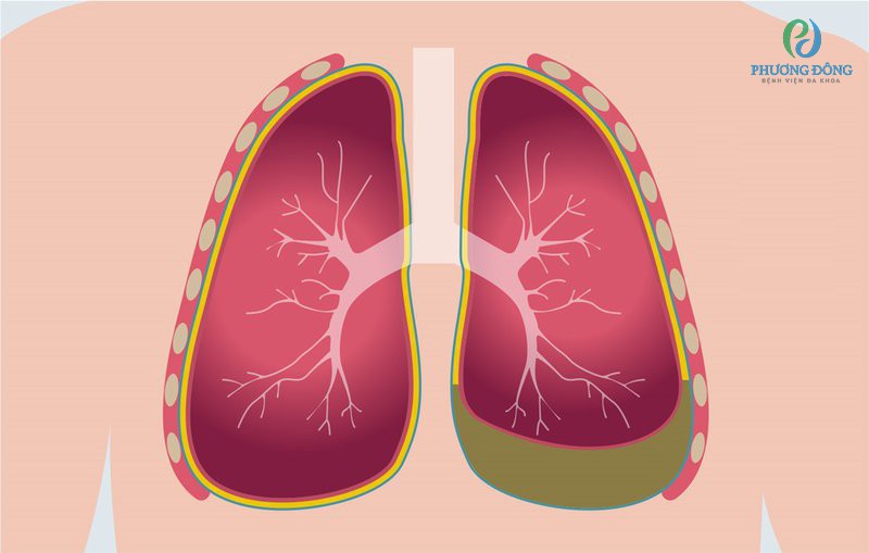 Bệnh có thể gây biến chứng viêm màng phổi