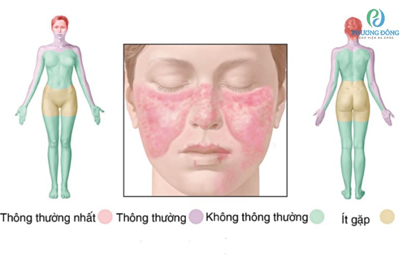 Lupus ban đỏ dạng đĩa loại toàn thân có thể xuất hiện ở bất kỳ vị trí khác trên da