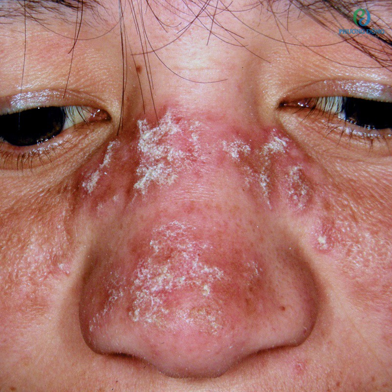 Hình ảnh các mần đỏ nổi gồ trên bề mặt da khi mắc lupus ban đỏ dạng đĩa
