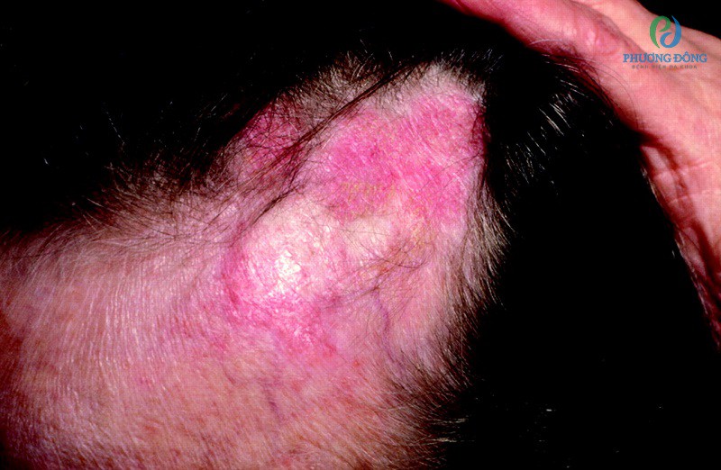 Bệnh Lupus ban đỏ dạng đĩa ở vùng da đầu khiến tóc rụng vĩnh viễn