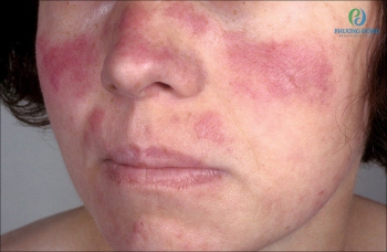 Lupus ban đỏ dạng đĩa: Dấu hiệu, cách điều trị bệnh hiện nay