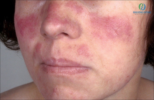 Lupus ban đỏ dạng đĩa: Dấu hiệu, cách điều trị bệnh hiện nay