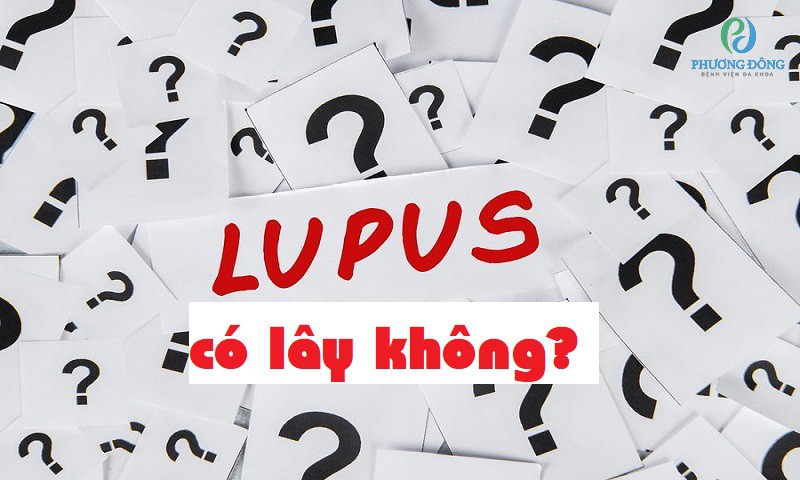 Có những triệu chứng chính của bệnh lupus ban đỏ là gì?
