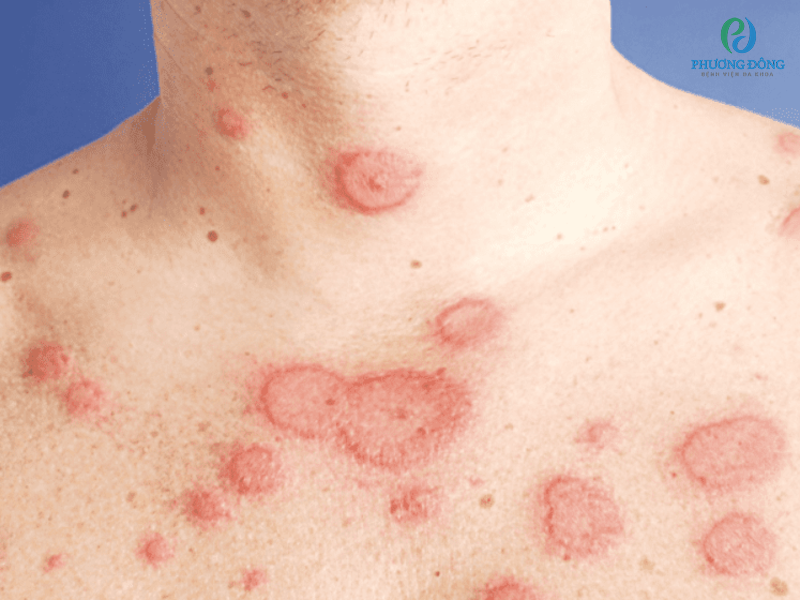 Triệu chứng ở da là phổ biến nhất của căn bệnh Lupus ban đỏ