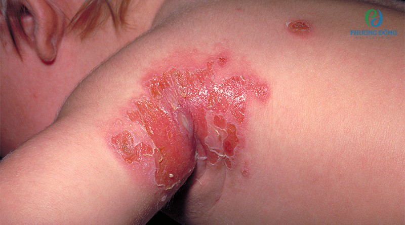 Vết thương hở khi tiếp xúc với nguồn bệnh sẽ gây nên viêm nhiễm mô tế bào