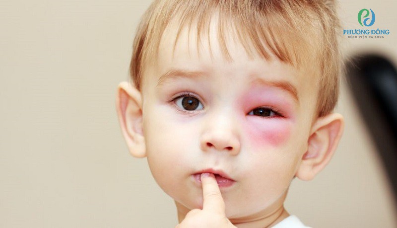 Viêm nhiễm mô mềm ở vùng hốc mắt thường gặp ở trẻ em dưới 6 tuổi