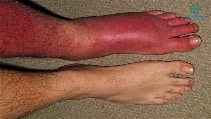 Viêm mô tế bào ở vùng cẳng chân là bệnh lý khá nguy hiểm