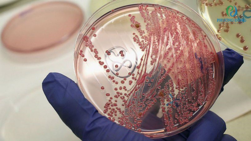 Tác nhân gây bệnh chính của viêm nhiễm bàng quang chính là vi khuẩn E-coli