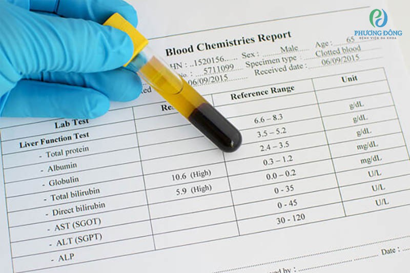 Cần kết hợp nhiều loại xét nghiệm chỉ số chức năng gan để chẩn đoán chính xác bệnh gan mật