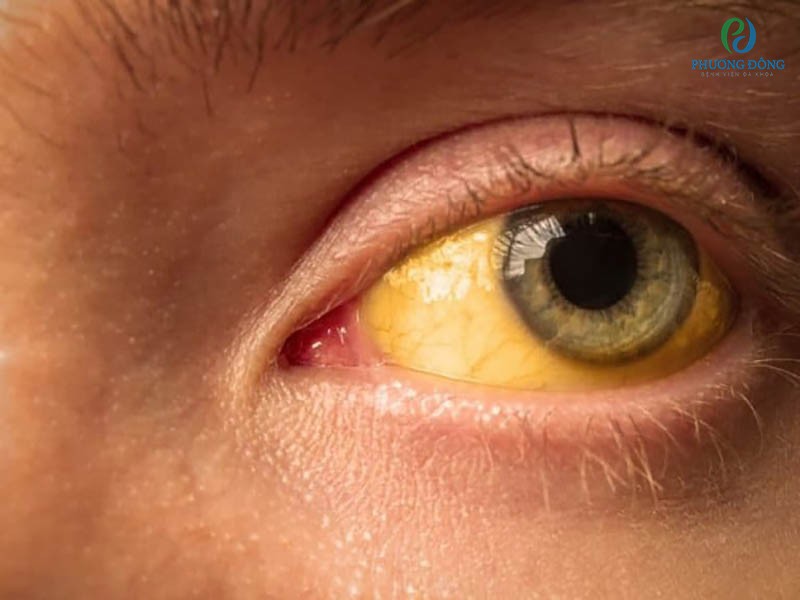 Chỉ số Albumin cao dẫn tới vàng mắt vàng da 