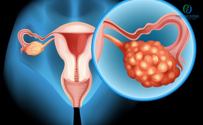 U nang buồng trứng chiếm khoảng 3,6% các bệnh phụ khoa thường gặp ở nữ giới
