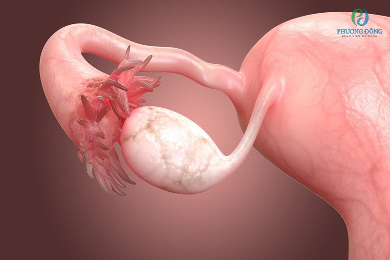 Nếu không điều trị kịp thời, u nang buồng trứng sẽ gây biến chứng nguy hiểm