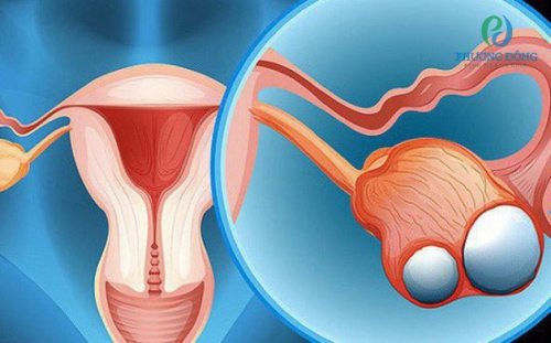 [Giải đáp thắc mắc] Cắt u nang buồng trứng có thai được không?