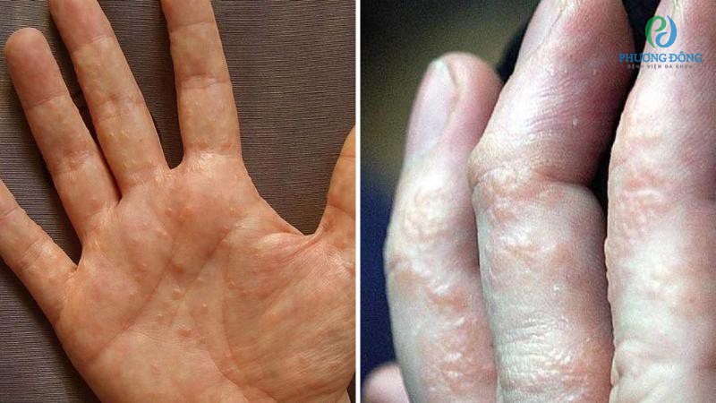 Chàm tổ đỉa thường xuất hiện ở lòng bàn tay, ngón tay, mu bàn tay, lòng bàn chân, ngón chân.