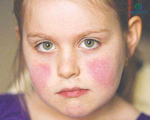 Lupus ban đỏ ở trẻ em là gì? Phát hiện sớm bệnh để có thể chữa trị