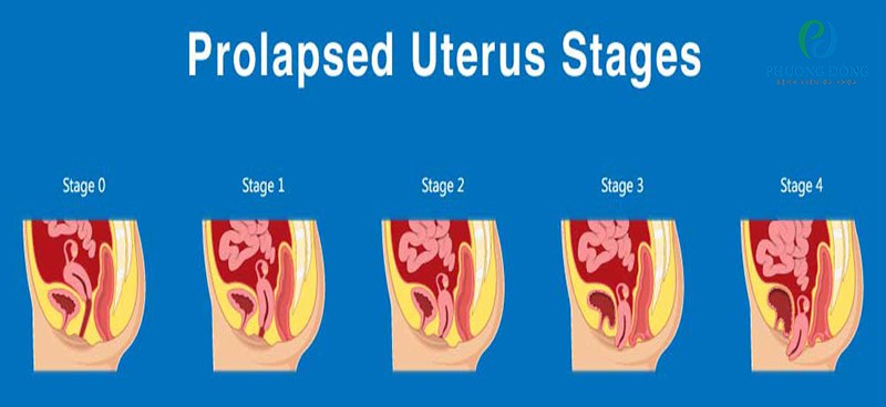 Các giai đoạn của hiện tượng sa tử cung sau sinh ở phụ nữ
