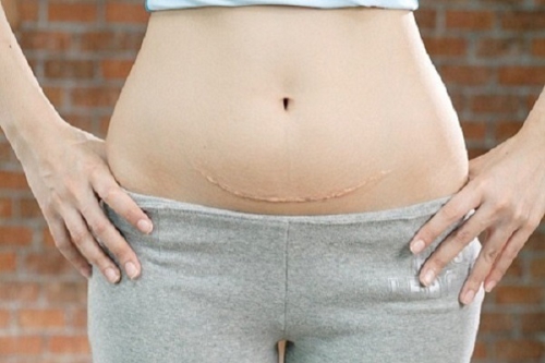 Sinh mổ bao lâu thì tắm được và tư vấn của bác sĩ chuyên khoa